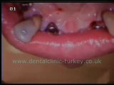 Anette Gotal (upper jaw 6 implants)