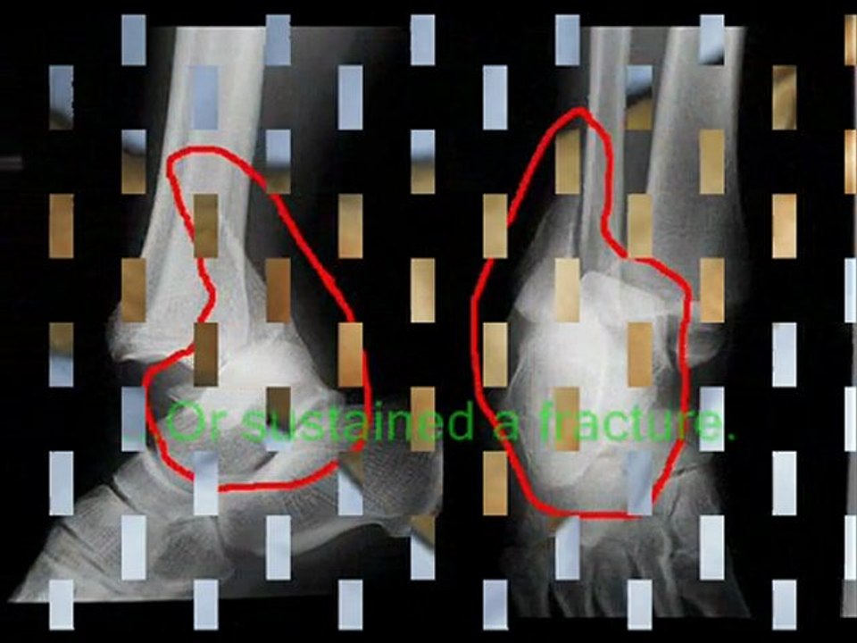 Ankle Sprain and Fractures