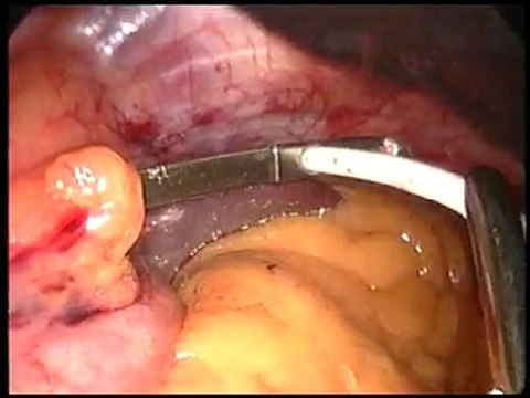 Lap Band Weight Loss Surgery San Antonio TX