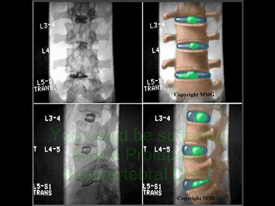 Prolapsed Intervertebral Disc