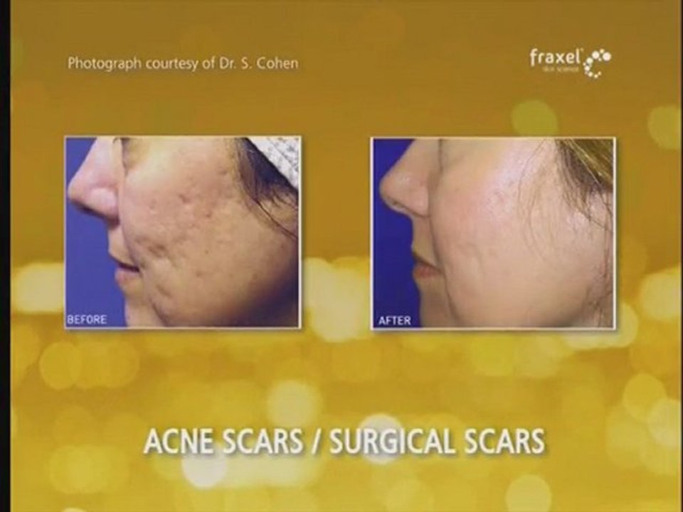 Fraxel - Fraxel Acne - Fraxel Laser Treatment - Sydney