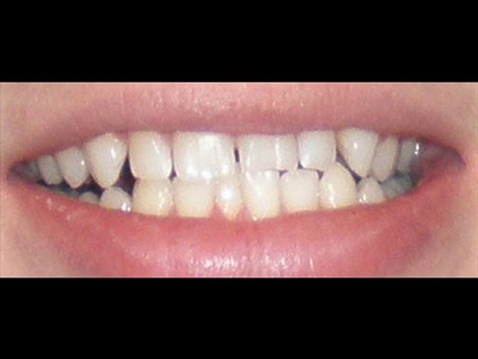 Crest Whitestrips Supreme