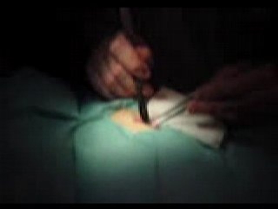 césarienne 2ème partie (suite)