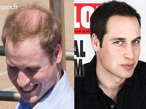 Le Prince William gomme... sa calvitie ?