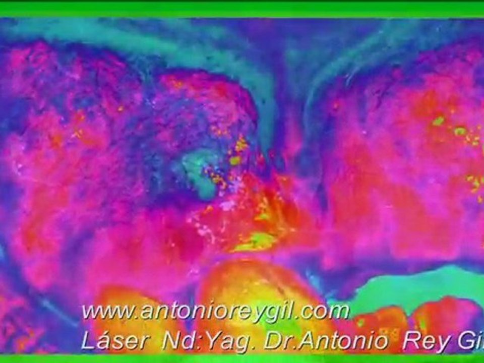 Dr.ANTONIO REY GIL  LASER Nd:Yag. ODONTOLOGIA TRATAMIENTO