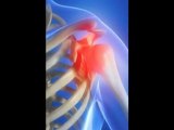 Exercises for Frozen Shoulder vs. Stretching