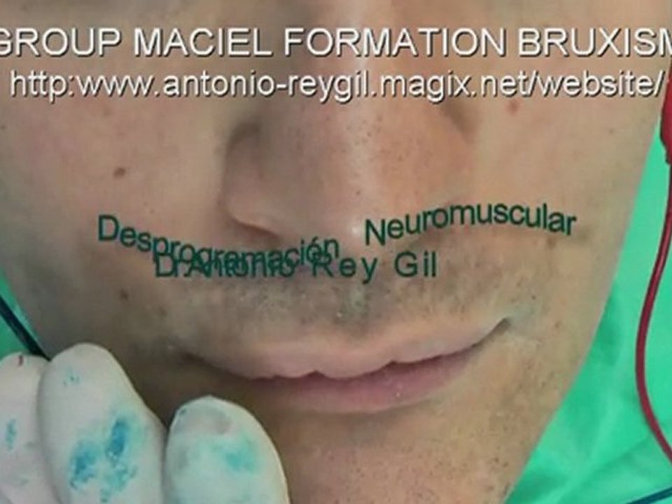 BRUXISMO  Tratamiento,DESPROGRAMACION Drs-REY-Maciel .Video