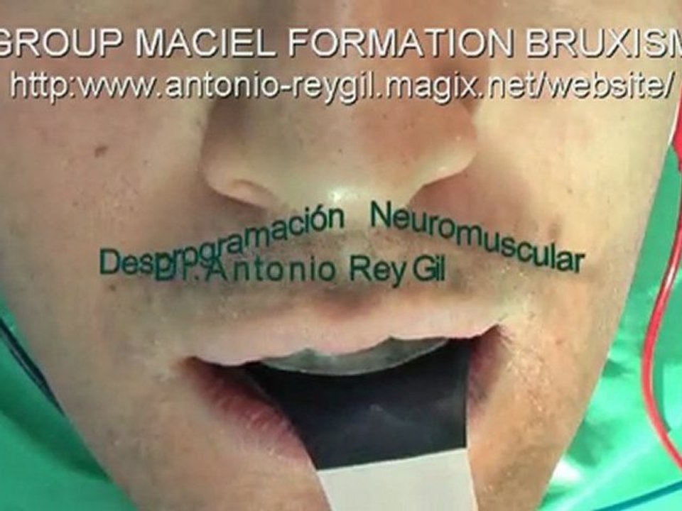 2-Video BRUXISMO DESPROGRAMACION Drs REY-MACIEL-BORGES