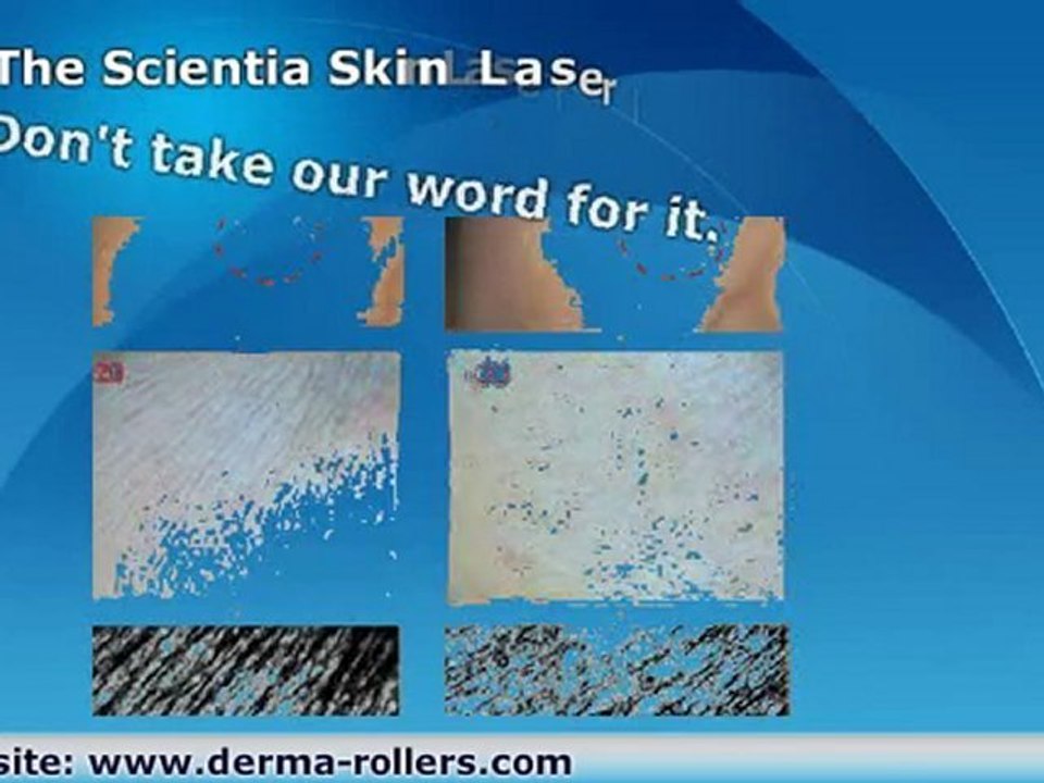 Skin After Laser Treatment