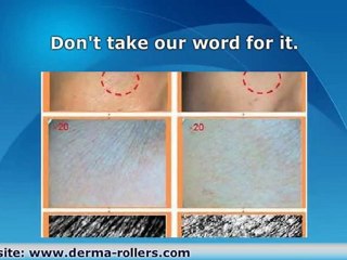 Laser For Asian Skin