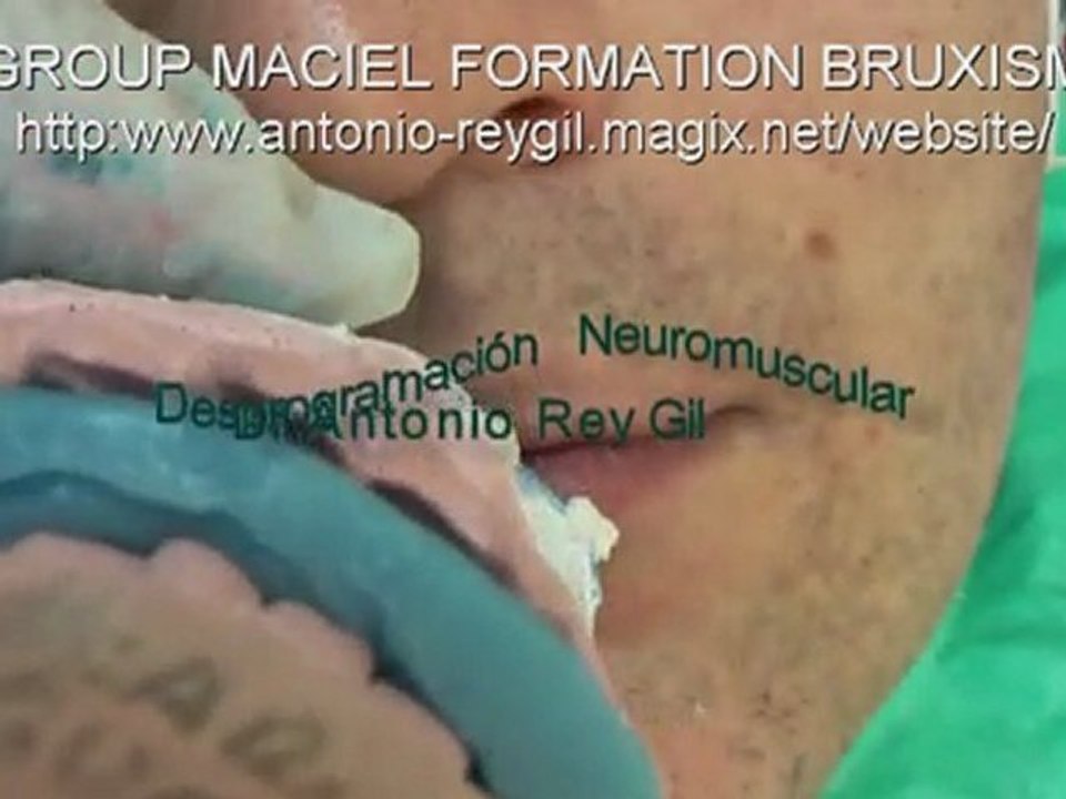 5-Video BRUXISMO DESPROGRAMACION Drs REY-MACIEL-BORGES