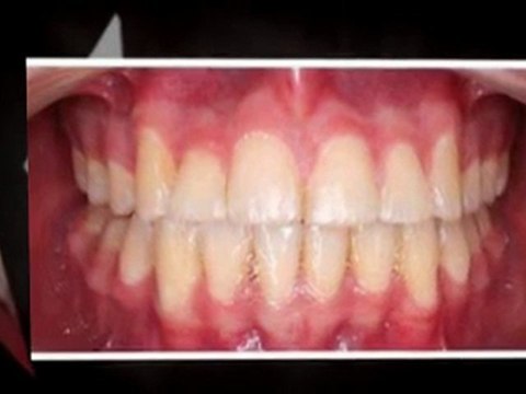 Orthodontist Fort Collins - See What Braces Can Do For You!