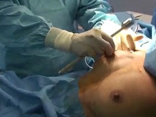 Pose d implants mammaire sous hypnose