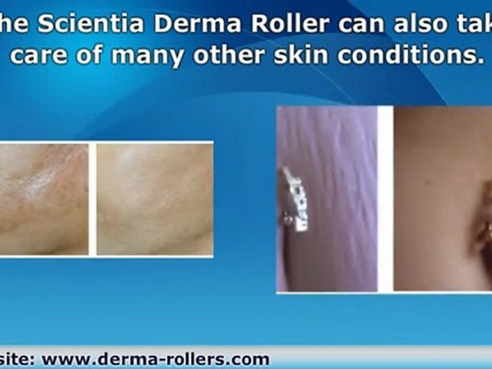 Remove Surgery Scars