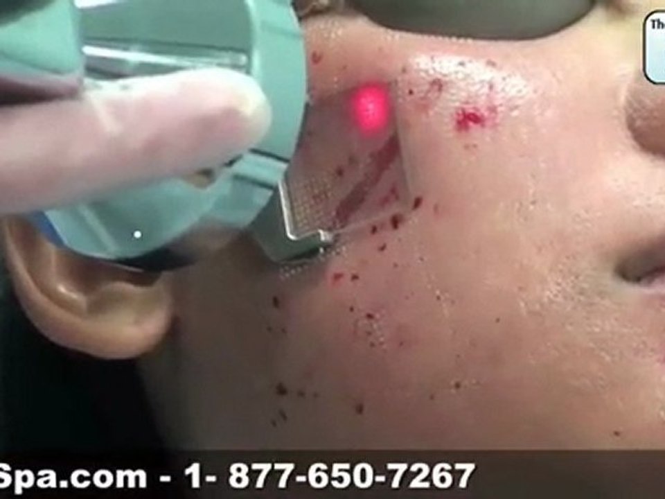 FX Laser Treatment