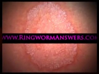 ringworm treatment