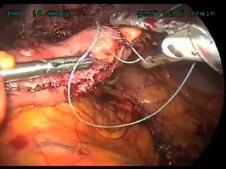 Failed Lap Band to Gastric Imbrication; A New Concept in Bar