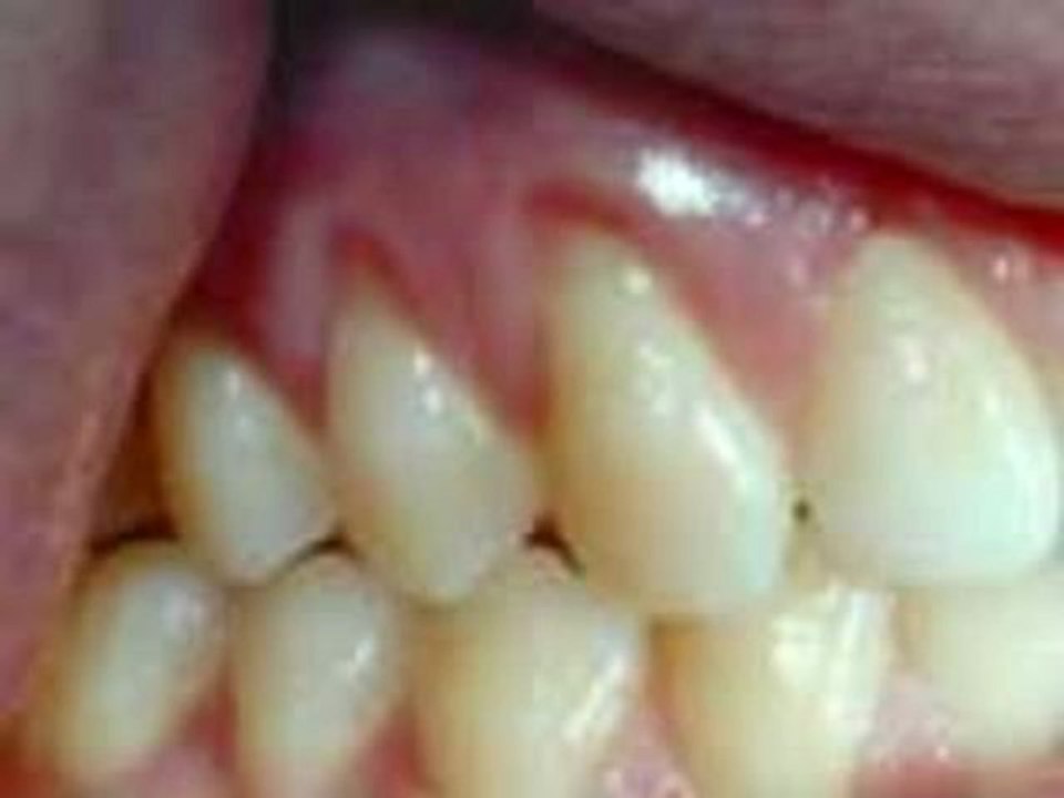 Avoid Gum Surgery & Stop Gum & Periodontal Disease Protect