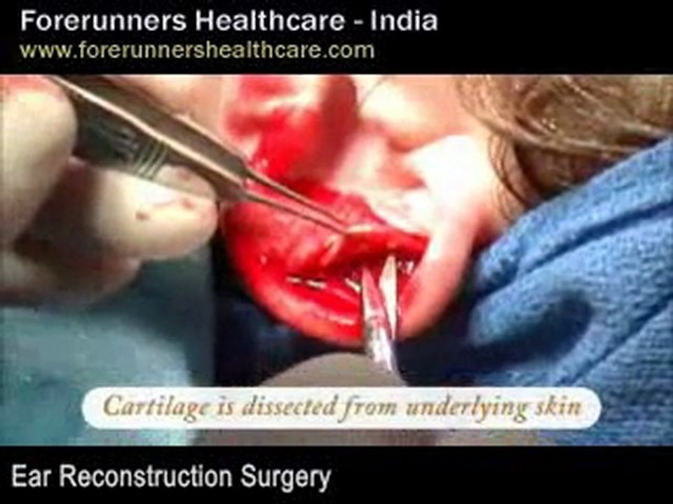 Ear Reconstruction Surgery in India at an affordable price