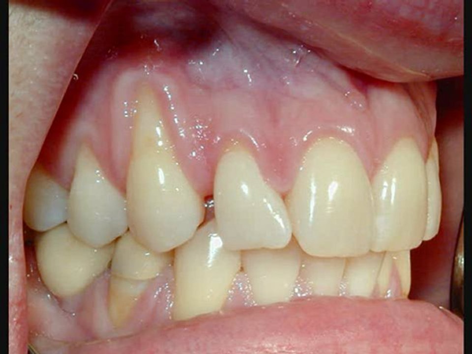 Gum Disease Stop Gum Disease Cure Gum Disease End GumDisease