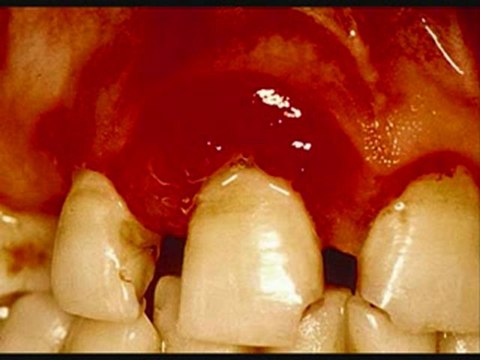 Gum Bleeding Stop Bleeding Gums Cure Bleed Gum End Bleed