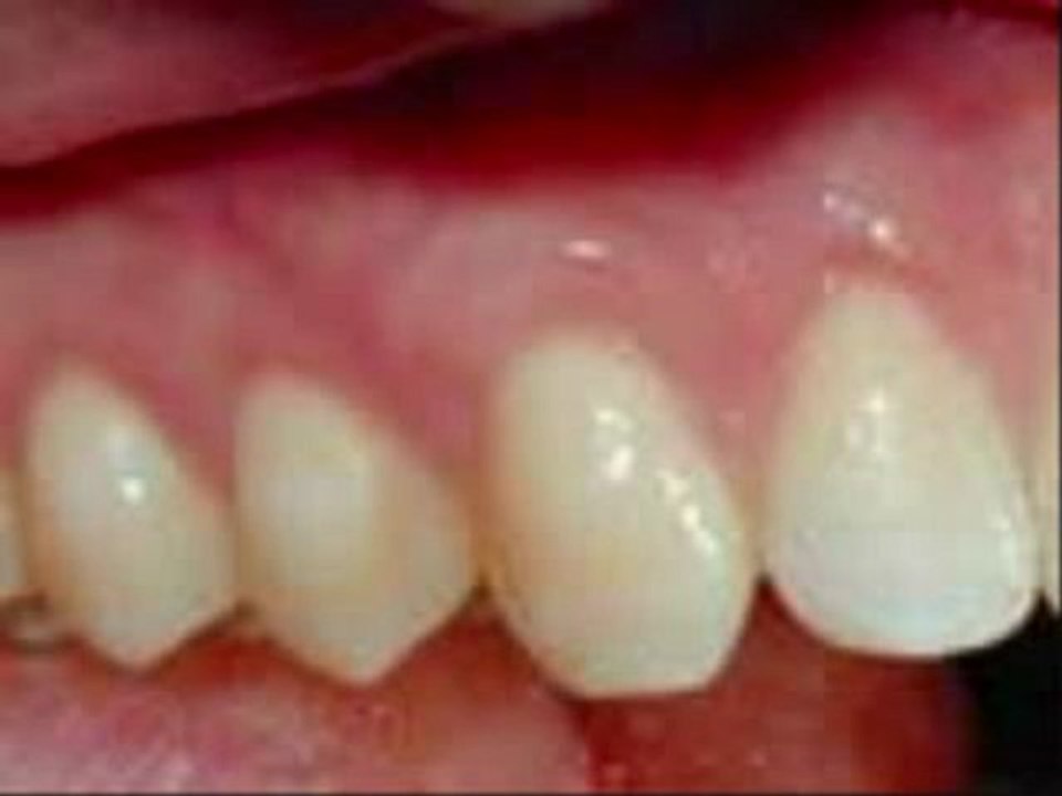 Stop Disease Gum Stop Gum Disease Stopping Gums Stopped