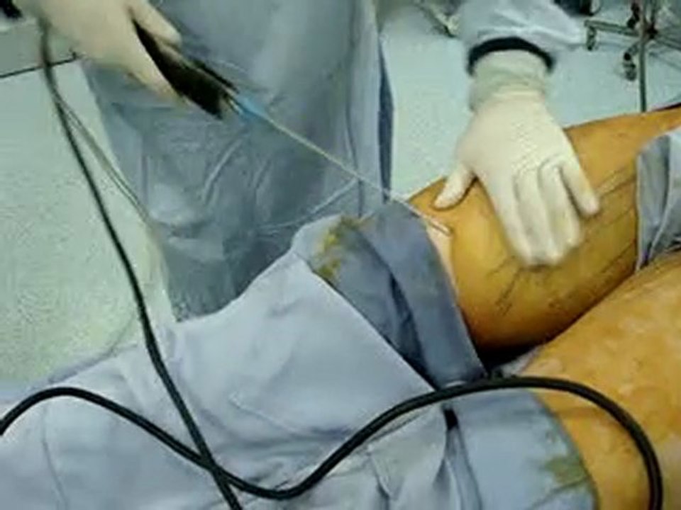 liposuction