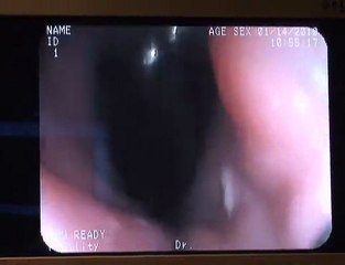 Video: Texas Bariatric Professionals Perform an EGD