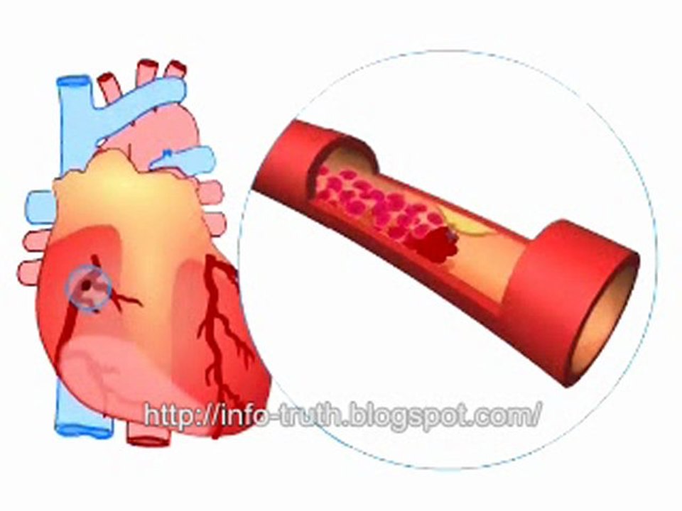 ** What Causes A heart attack **