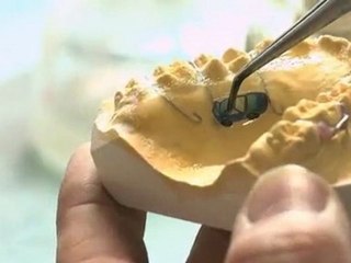 Orthodontie laser : création appareils dentaires - Nice