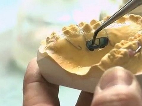 Orthodontie laser : création appareils dentaires - Nice