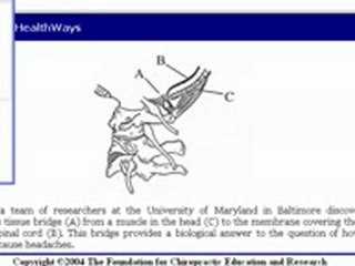 Michigan Chiropractor Dr Zachary Ward - Headaches Cervicogenic