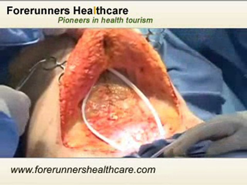 Get Cost Effective Cosmetic Surgery in India under Talented