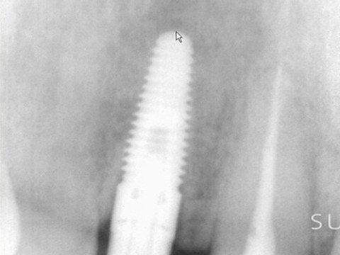 Intraoral Case Studies Imaged with Suni Sensors: Chapter 2