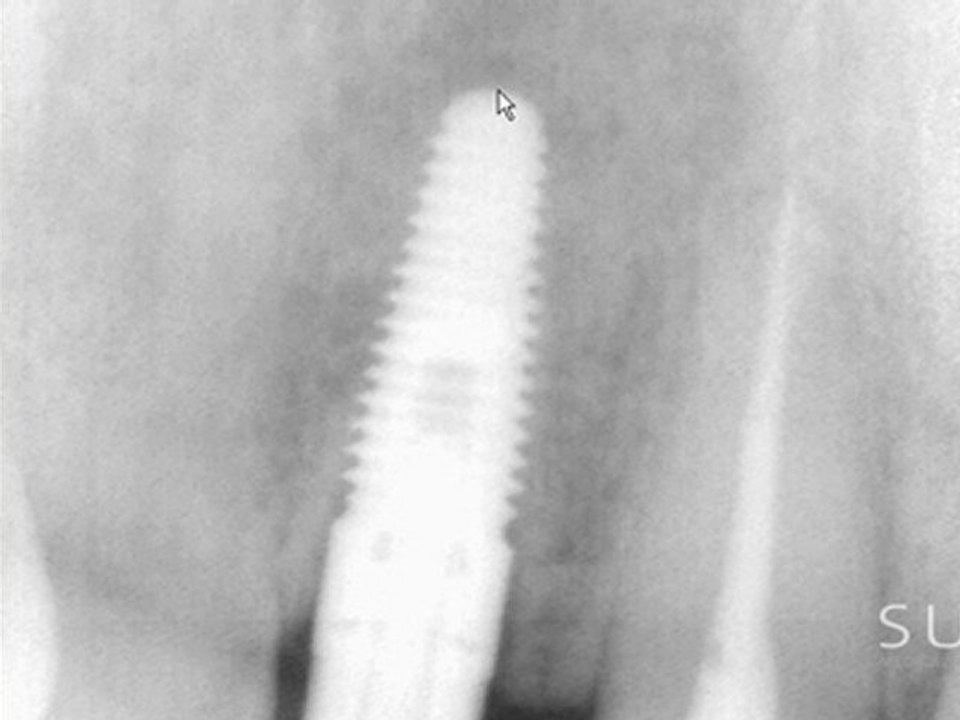 Intraoral Case Studies Imaged with Suni Sensors: Chapter 2