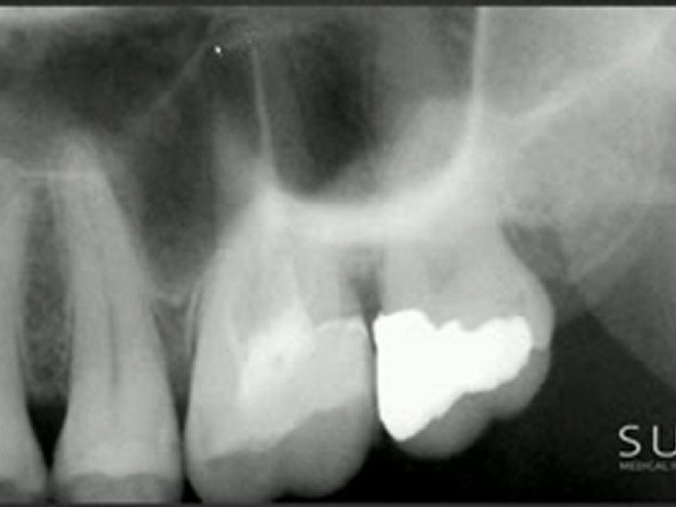 Intraoral Case Studies Imaged with Suni Sensors: Chapter 4