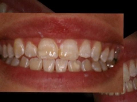 Cosmetic Dentist Dr. Brad Sammons DDS, Indianapolis Indiana