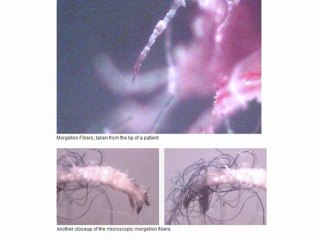 Morgellons