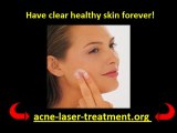 How To Get Rid Of Acne using laser treatment