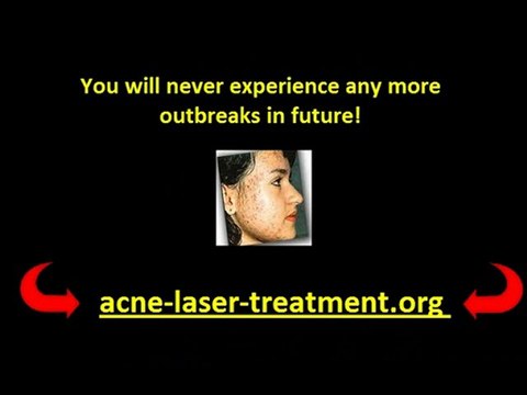 Laser Acne Scar Removal Treatment Patient