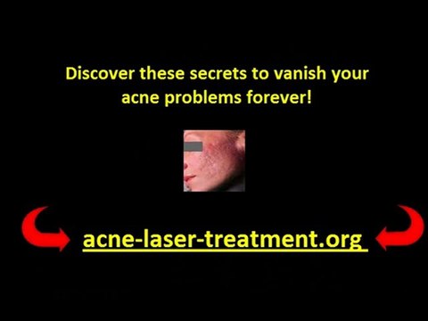Acne Scars laser treatment