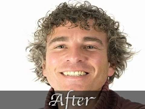 Hair Loss Replacement Orange County California