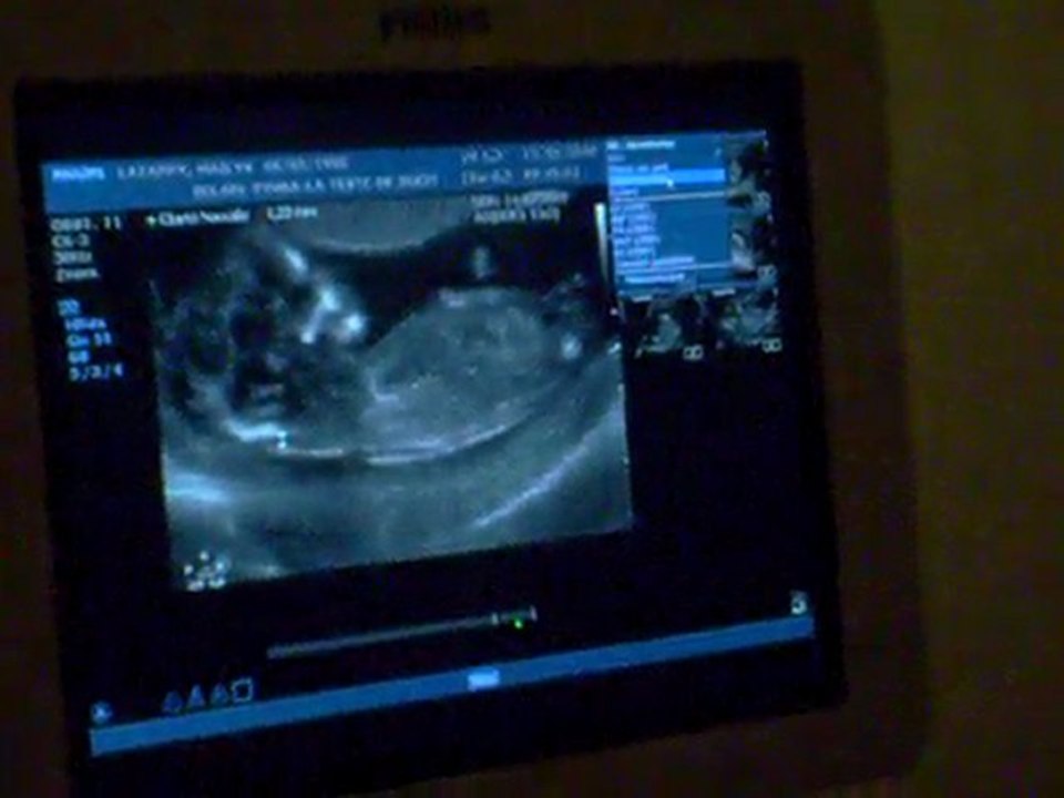 Echographie Premier Trimestre