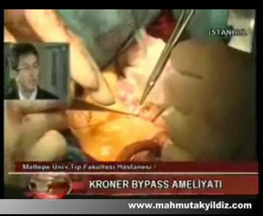 Koroner Bypass Ameliyatı - Op. Dr. Mahmut Akyıldız
