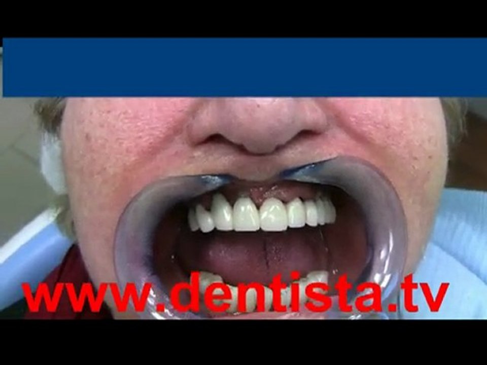 DENTISTA PREZZI IMPLANTOLOGIA