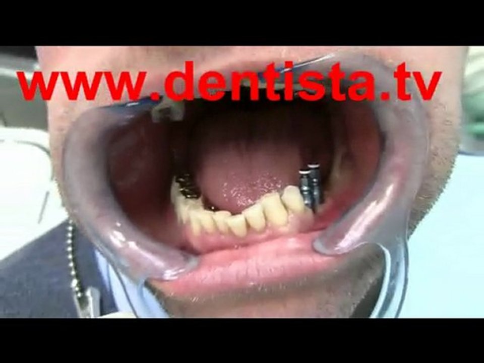 IMPLANTOLOGIA DENTISTA