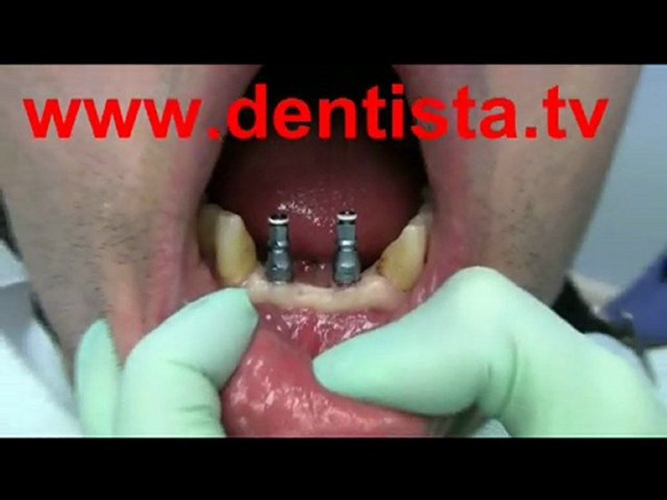 DENTISTA IMPLANTOLOGIA TRANSMUCOSA PREZZI IMPIANTI DENTALI