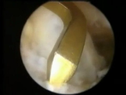 Ön Çapraz Bağ Onarımı