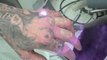 Tattoo Removal - Skull Tattoos on Fingers