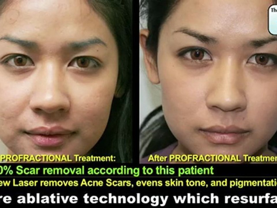 Profractional Laser Acne Scar Removal